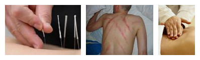 Acupuncture, Gua Sha and Tui Na