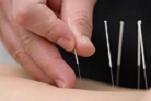 Acupunture 